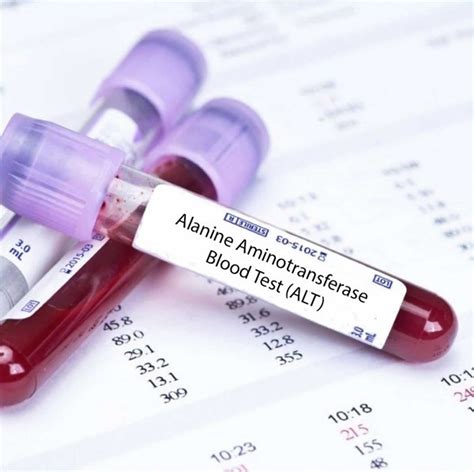 high alt levels in blood test.